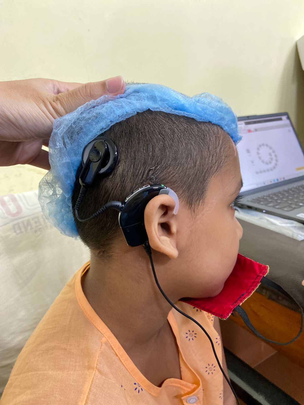 Cochlear Implant 1